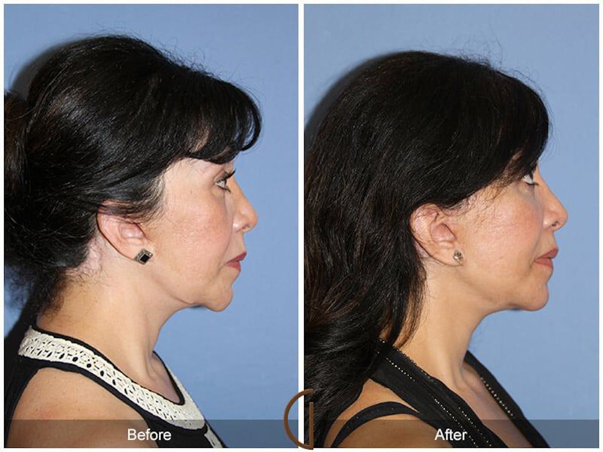 Facial Fat Grafting Before & After Gallery - Patient 180198 - Image 3