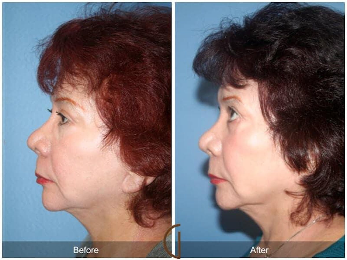 Facial Fat Grafting Before & After Gallery - Patient 397100 - Image 1