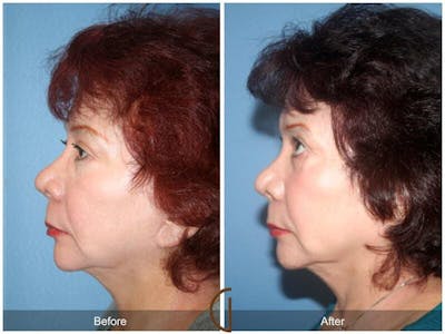 Facial Fat Grafting Before & After Gallery - Patient 397100 - Image 1