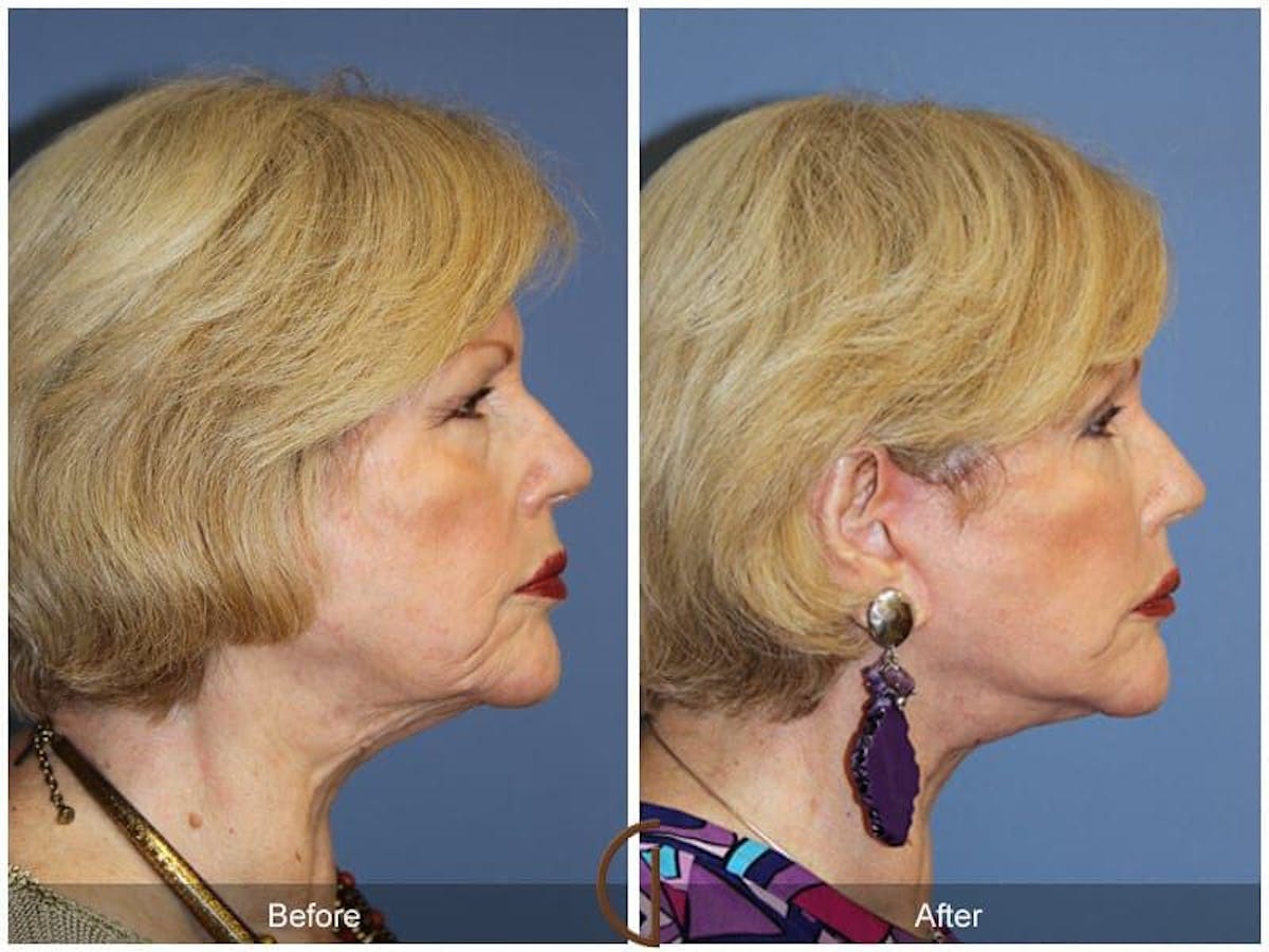 Facial Fat Grafting Before & After Gallery - Patient 216448 - Image 3