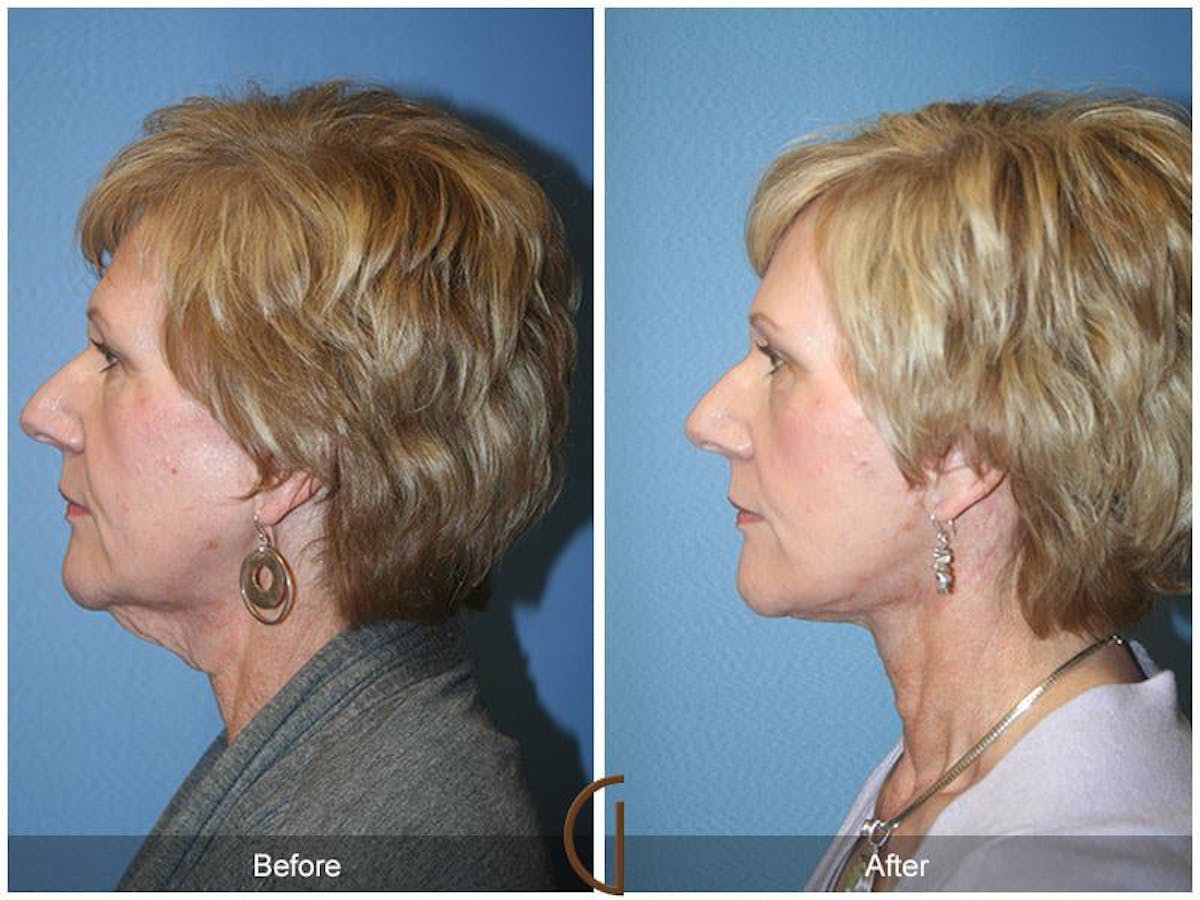 Facial Fat Grafting Before & After Gallery - Patient 134735 - Image 1