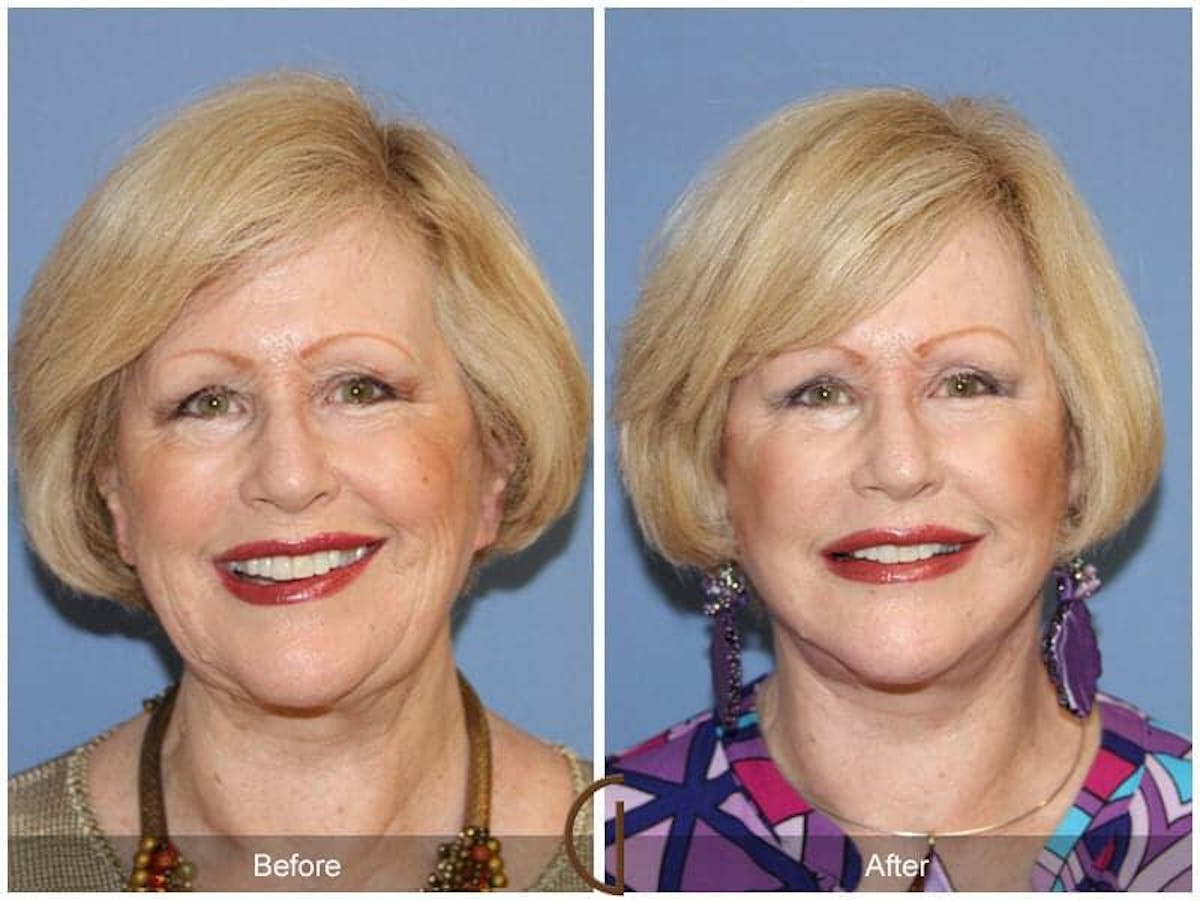Facial Fat Grafting Before & After Gallery - Patient 216448 - Image 2