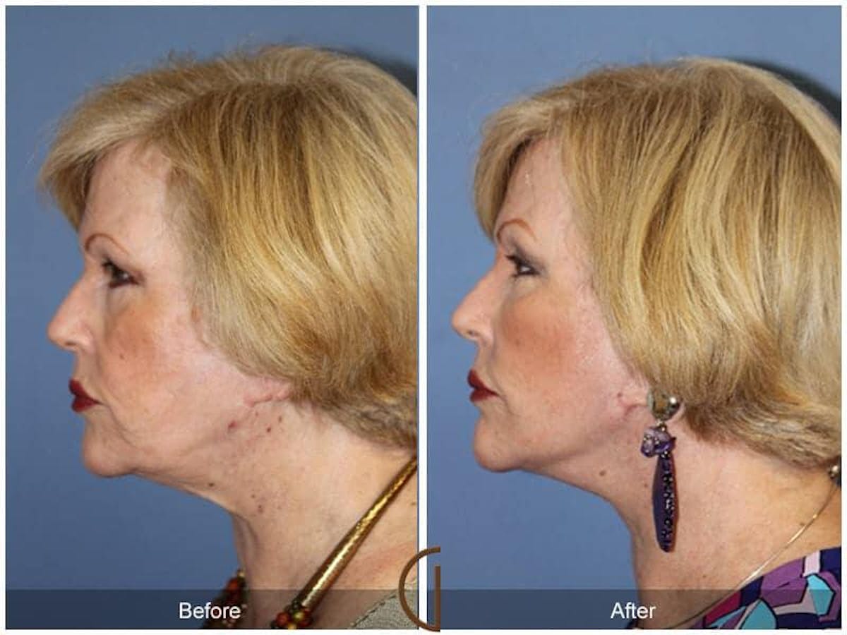 Facial Fat Grafting Before & After Gallery - Patient 216448 - Image 1