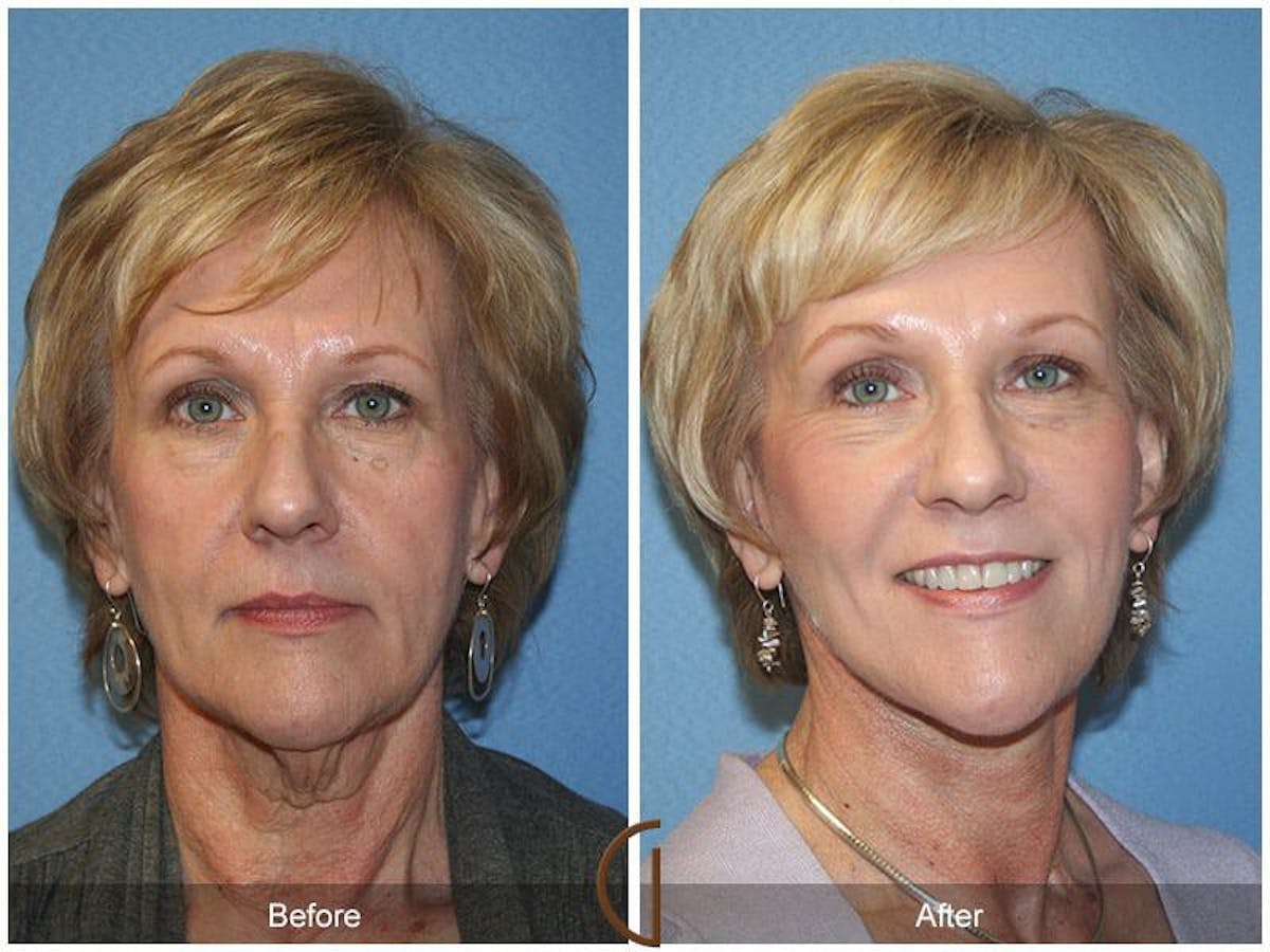 Facial Fat Grafting Before & After Gallery - Patient 134735 - Image 2