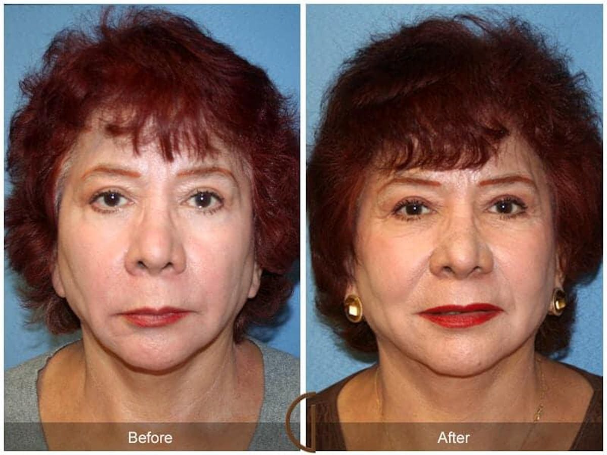 Facial Fat Grafting Before & After Gallery - Patient 397100 - Image 2
