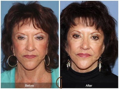 Facial Fat Grafting Before & After Gallery - Patient 183402 - Image 1