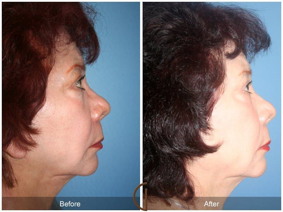Facial Fat Grafting Before & After Gallery - Patient 397100 - Image 3
