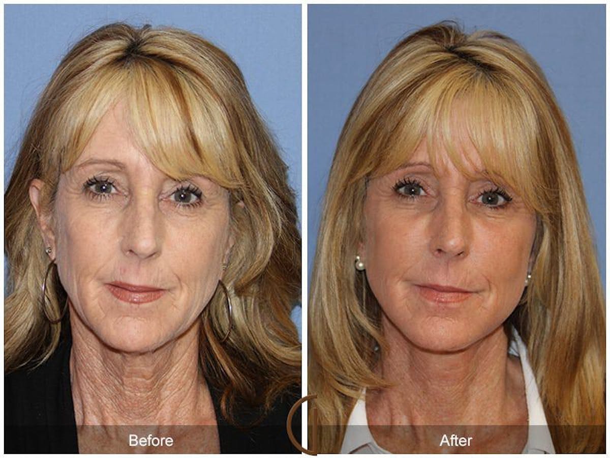 Facial Fat Grafting Before & After Gallery - Patient 293032 - Image 2