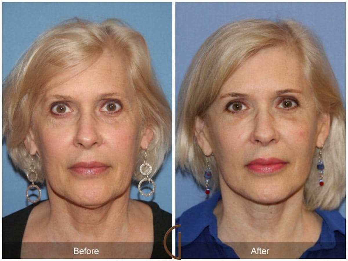 Facial Fat Grafting Before & After Gallery - Patient 501253 - Image 2