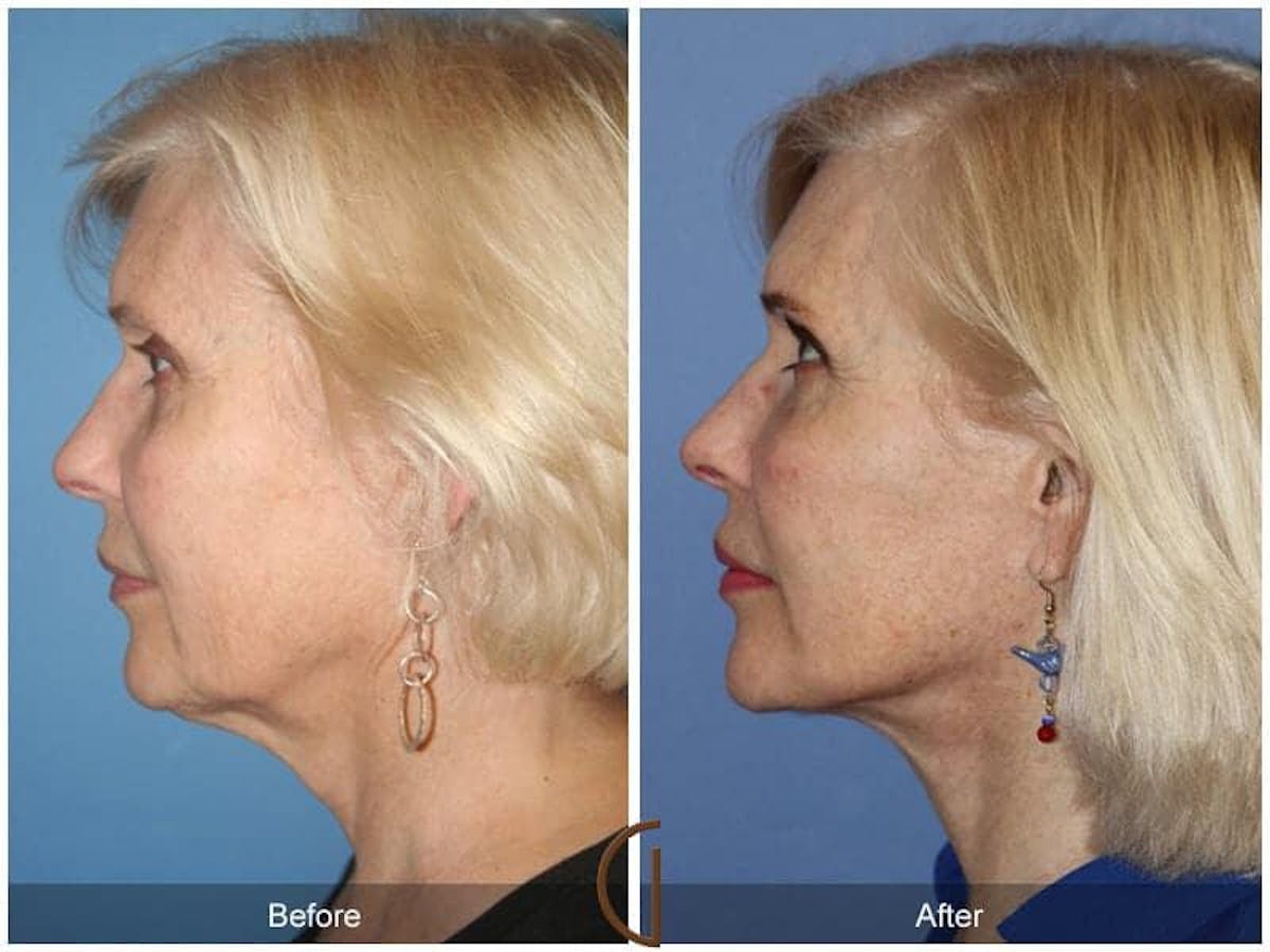 Facial Fat Grafting Before & After Gallery - Patient 501253 - Image 1