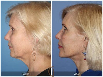 Facial Fat Grafting Before & After Gallery - Patient 501253 - Image 1