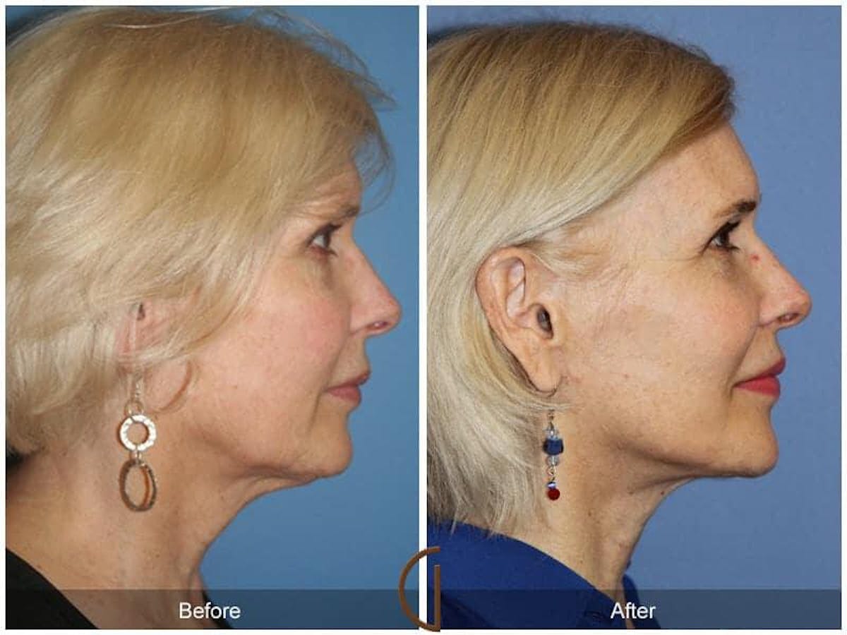 Facial Fat Grafting Before & After Gallery - Patient 501253 - Image 3