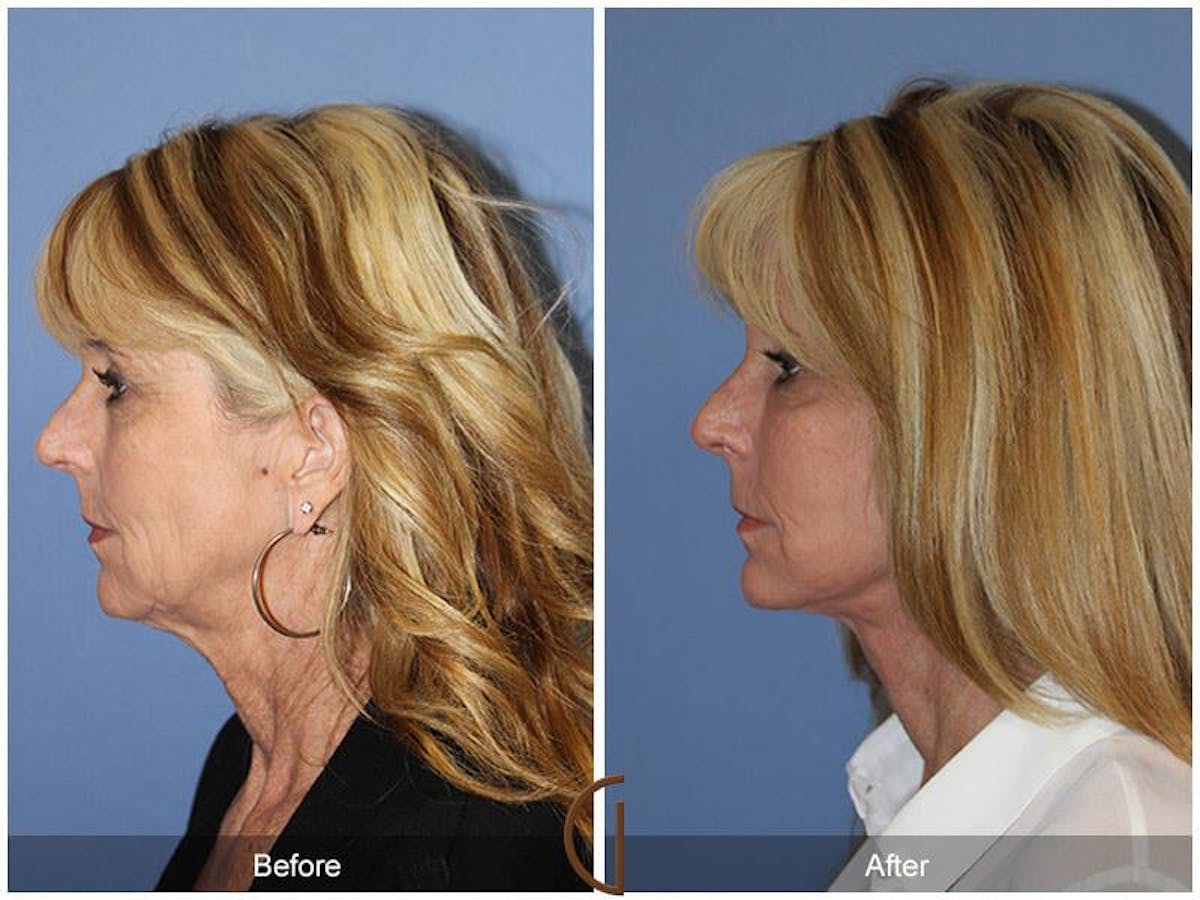 Facial Fat Grafting Before & After Gallery - Patient 293032 - Image 1
