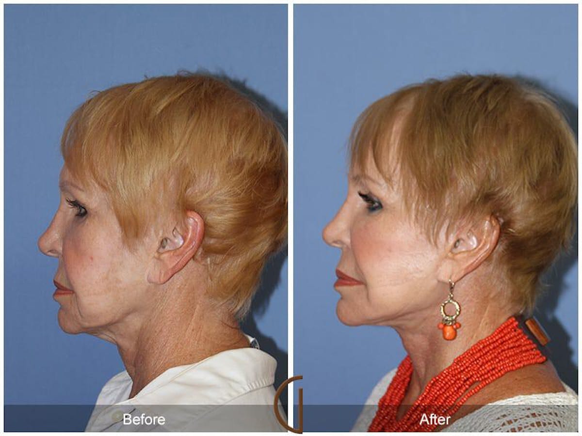 Facial Fat Grafting Before & After Gallery - Patient 402240 - Image 1
