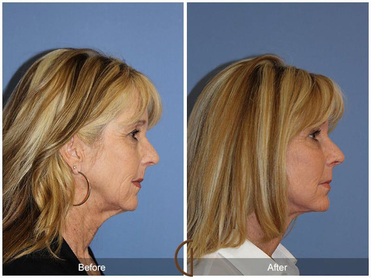 Facial Fat Grafting Before & After Gallery - Patient 293032 - Image 3