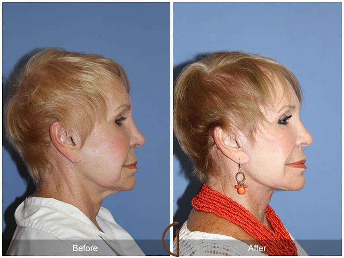 Facial Fat Grafting Before & After Gallery - Patient 402240 - Image 3