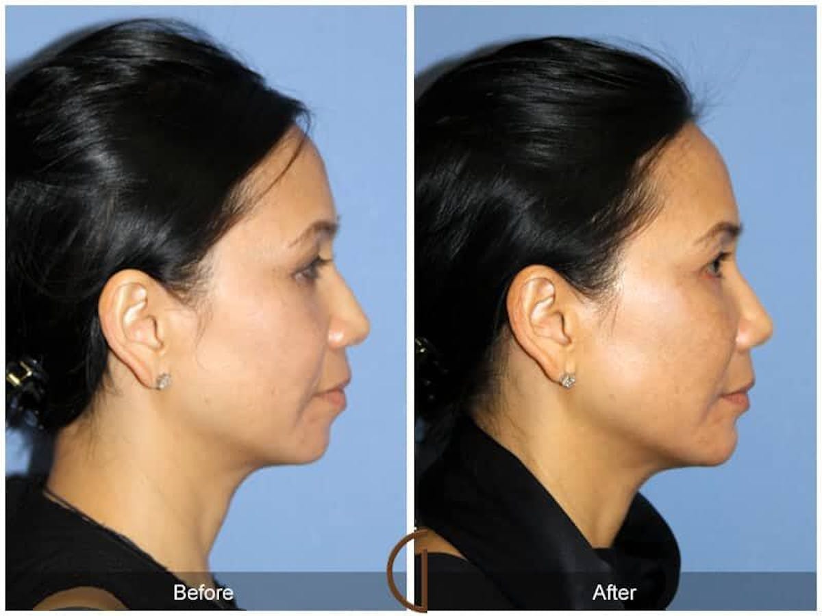 Facial Fat Grafting Before & After Gallery - Patient 374636 - Image 3