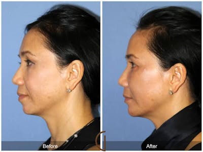 Facial Fat Grafting Before & After Gallery - Patient 374636 - Image 1