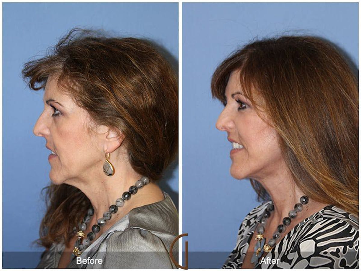 Facial Fat Grafting Before & After Gallery - Patient 629774 - Image 1