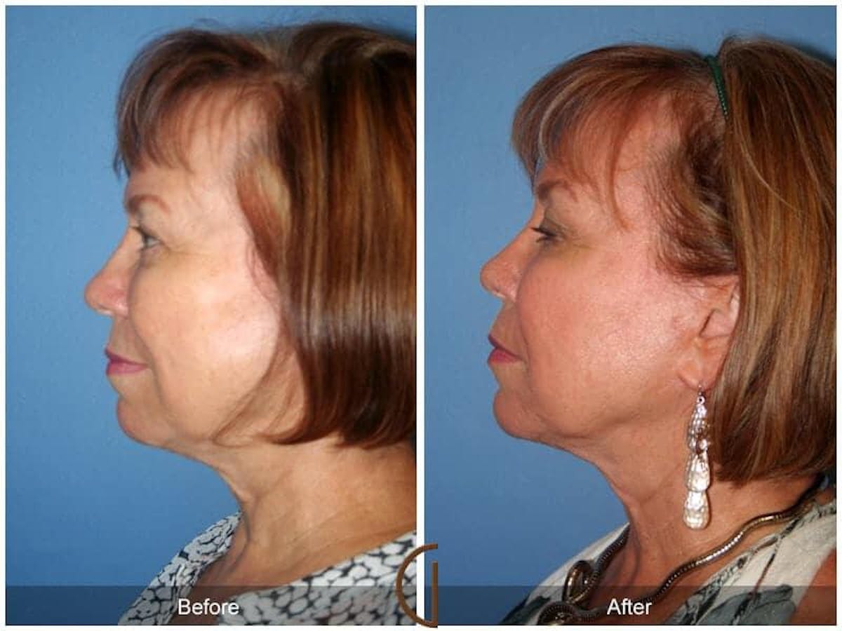 Facial Fat Grafting Before & After Gallery - Patient 377019 - Image 1