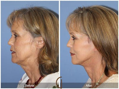 Facial Fat Grafting Before & After Gallery - Patient 341901 - Image 1