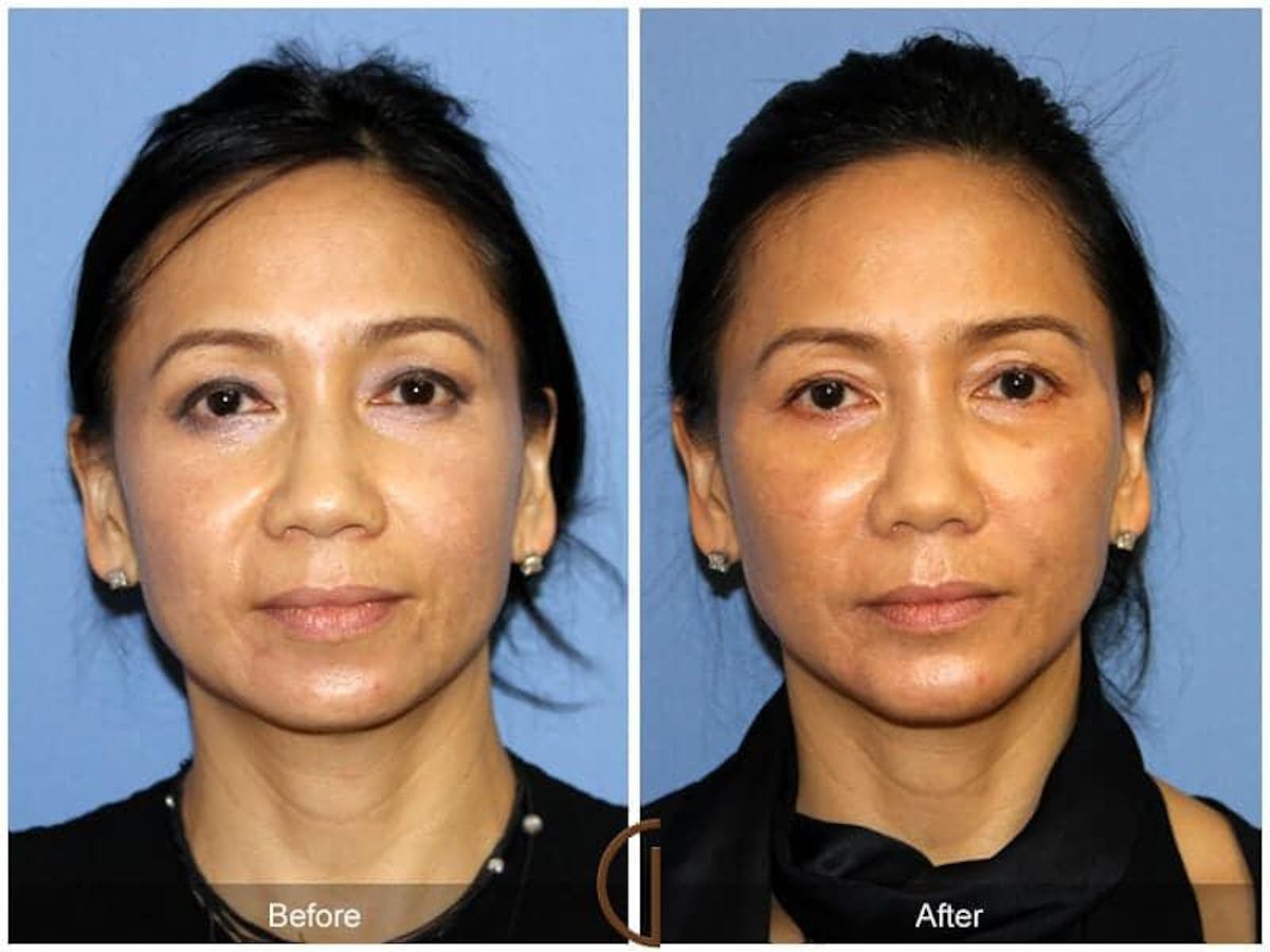 Facial Fat Grafting Before & After Gallery - Patient 374636 - Image 2