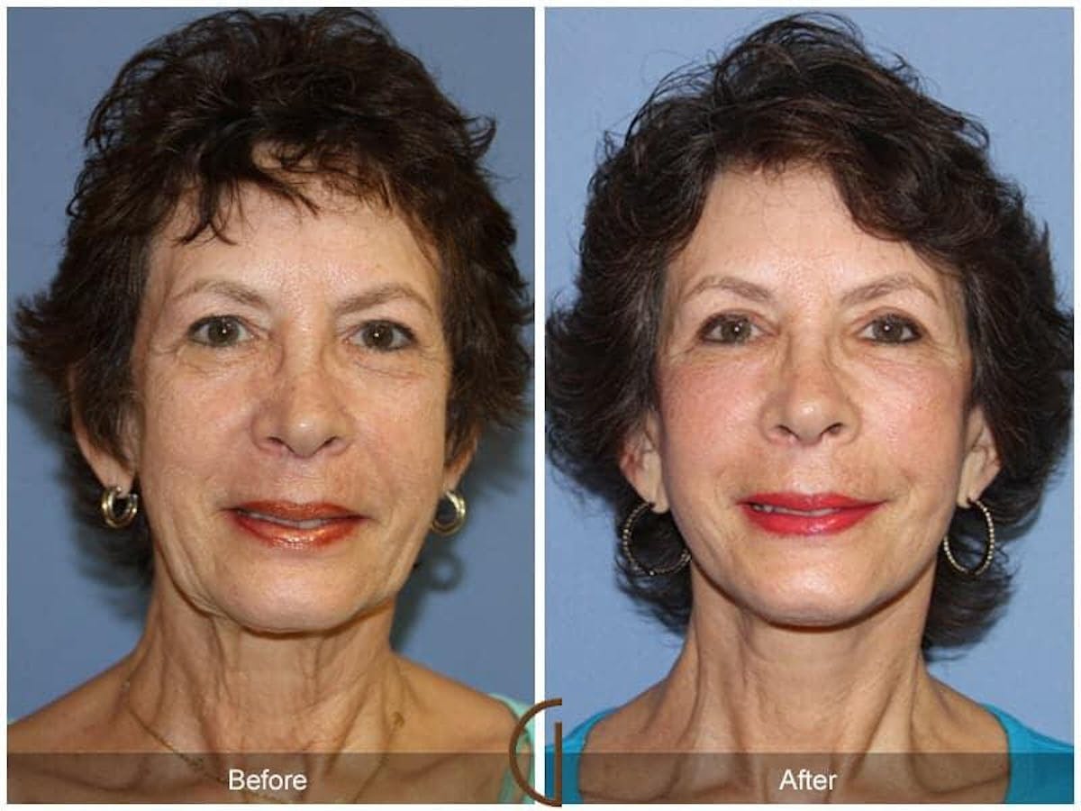 Facial Fat Grafting Before & After Gallery - Patient 141659 - Image 2