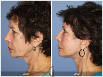 Facial Fat Grafting Before & After Gallery - Patient 141659 - Image 1