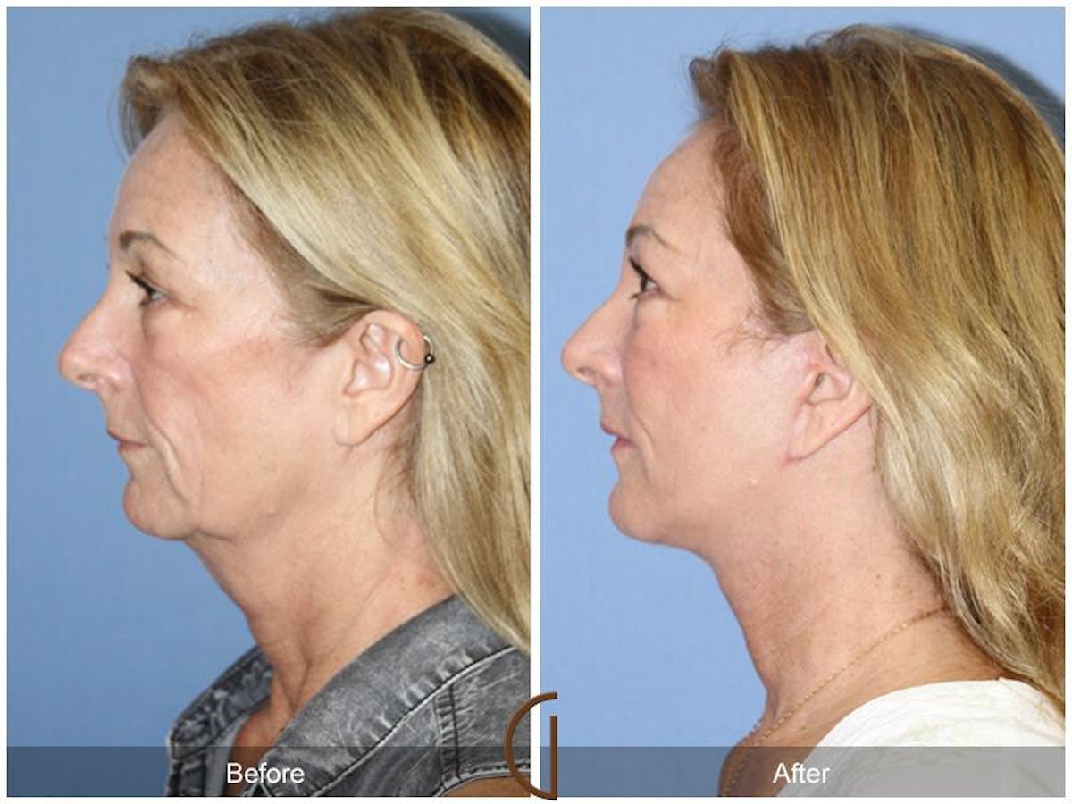 Facial Fat Grafting Before & After Gallery - Patient 943720 - Image 1