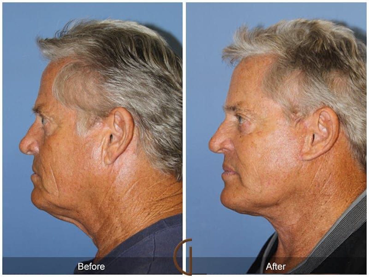 Facial Fat Grafting Before & After Gallery - Patient 112594 - Image 1