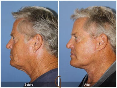 Facial Fat Grafting Before & After Gallery - Patient 112594 - Image 1