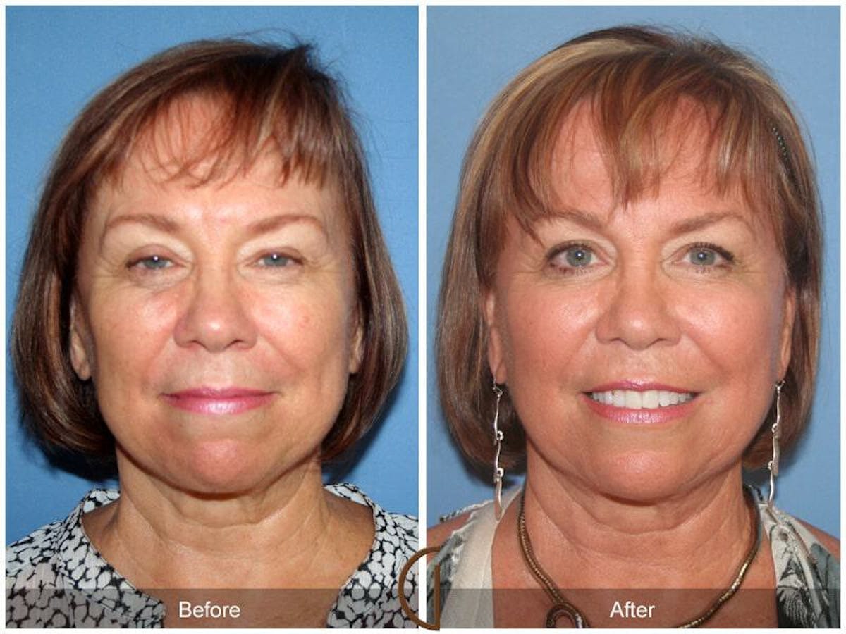 Facial Fat Grafting Before & After Gallery - Patient 377019 - Image 2