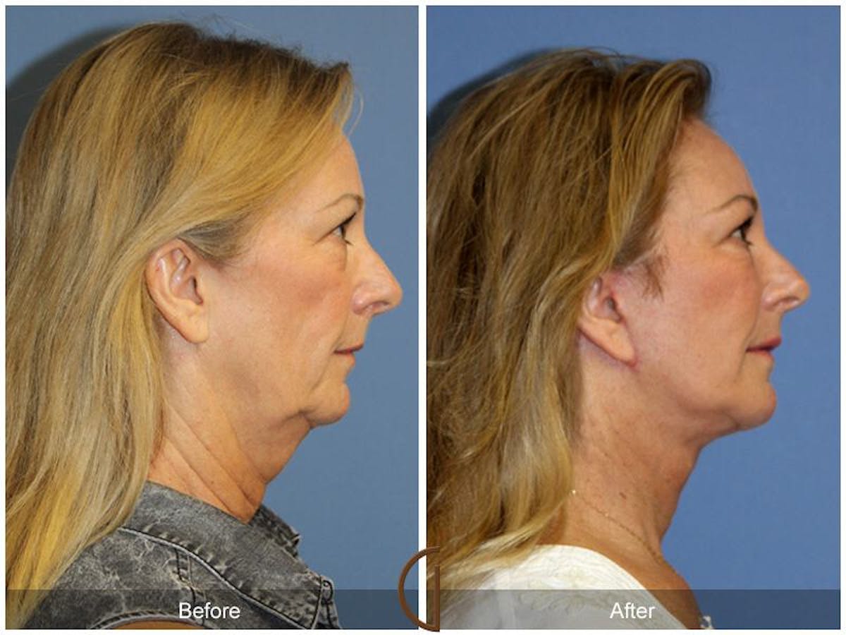 Facial Fat Grafting Before & After Gallery - Patient 943720 - Image 3