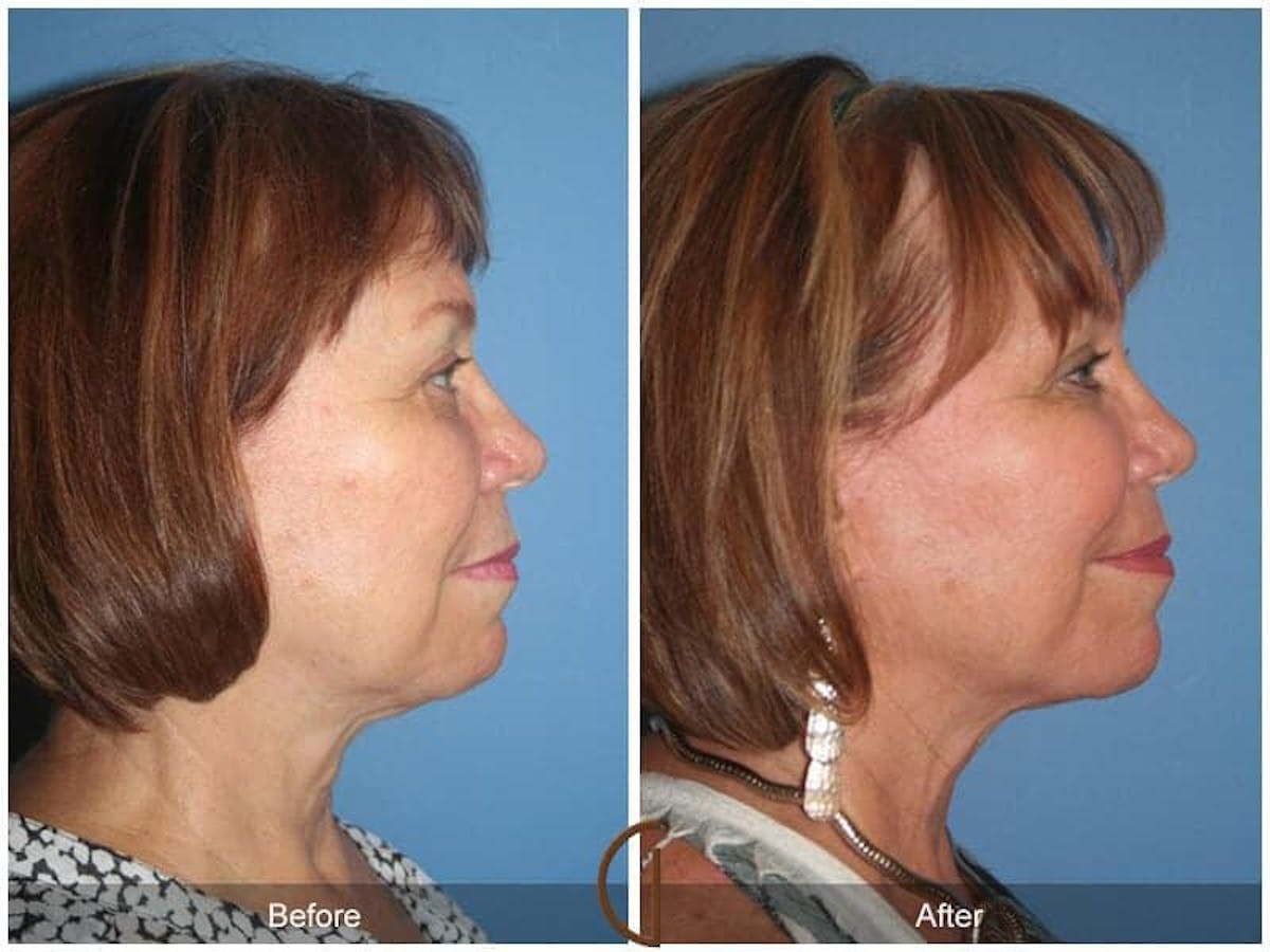 Facial Fat Grafting Before & After Gallery - Patient 377019 - Image 3