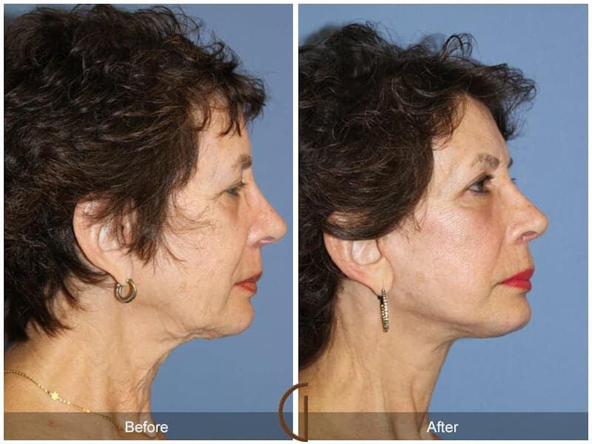Facial Fat Grafting Before & After Gallery - Patient 141659 - Image 3