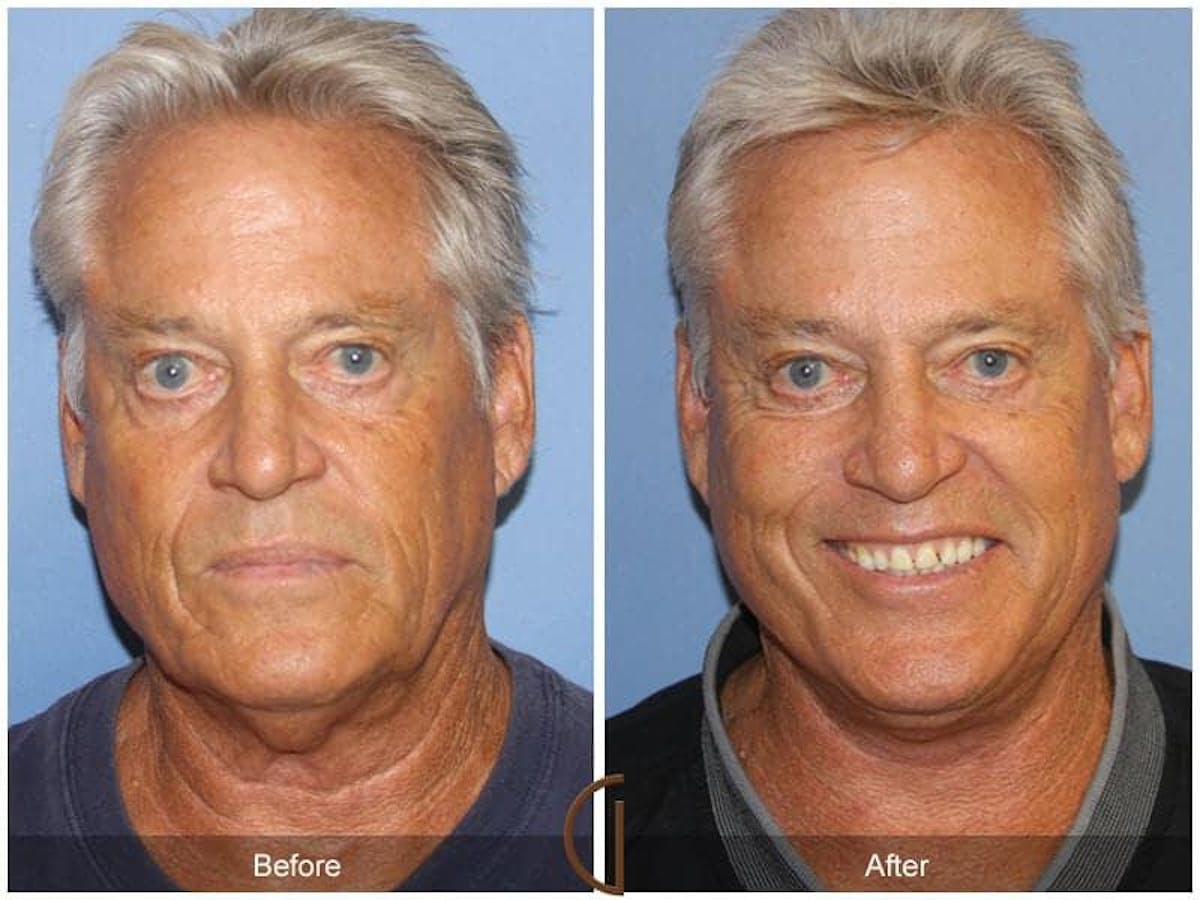 Facial Fat Grafting Before & After Gallery - Patient 112594 - Image 2