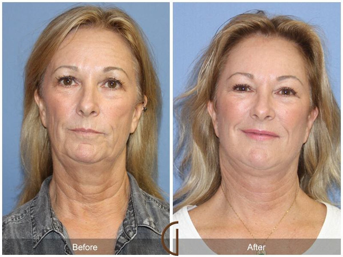 Facial Fat Grafting Before & After Gallery - Patient 943720 - Image 2