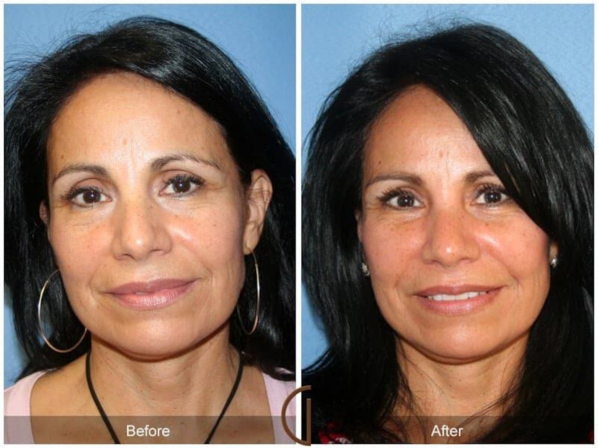 Facial Fat Grafting Before & After Gallery - Patient 224813 - Image 2