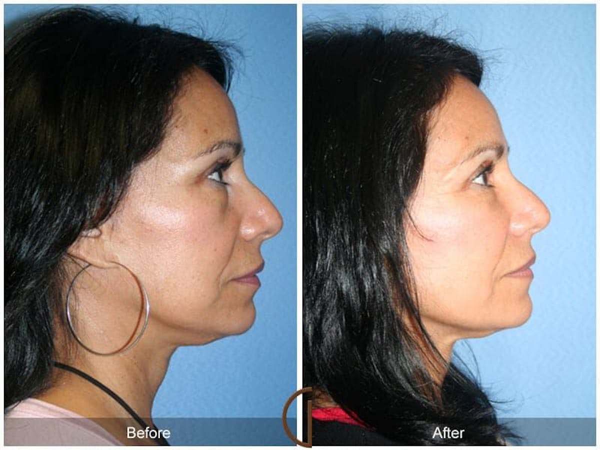 Facial Fat Grafting Before & After Gallery - Patient 224813 - Image 3