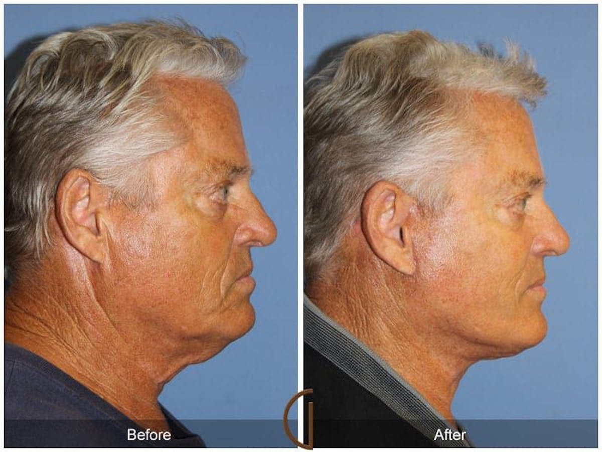 Facial Fat Grafting Before & After Gallery - Patient 112594 - Image 3