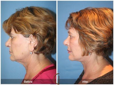 Facial Fat Grafting Before & After Gallery - Patient 357552 - Image 1