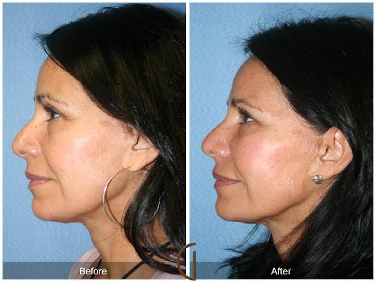 Facial Fat Grafting Before & After Gallery - Patient 224813 - Image 1