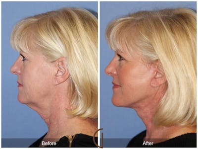 Eyelid Lift Before & After Gallery - Patient 385907 - Image 1