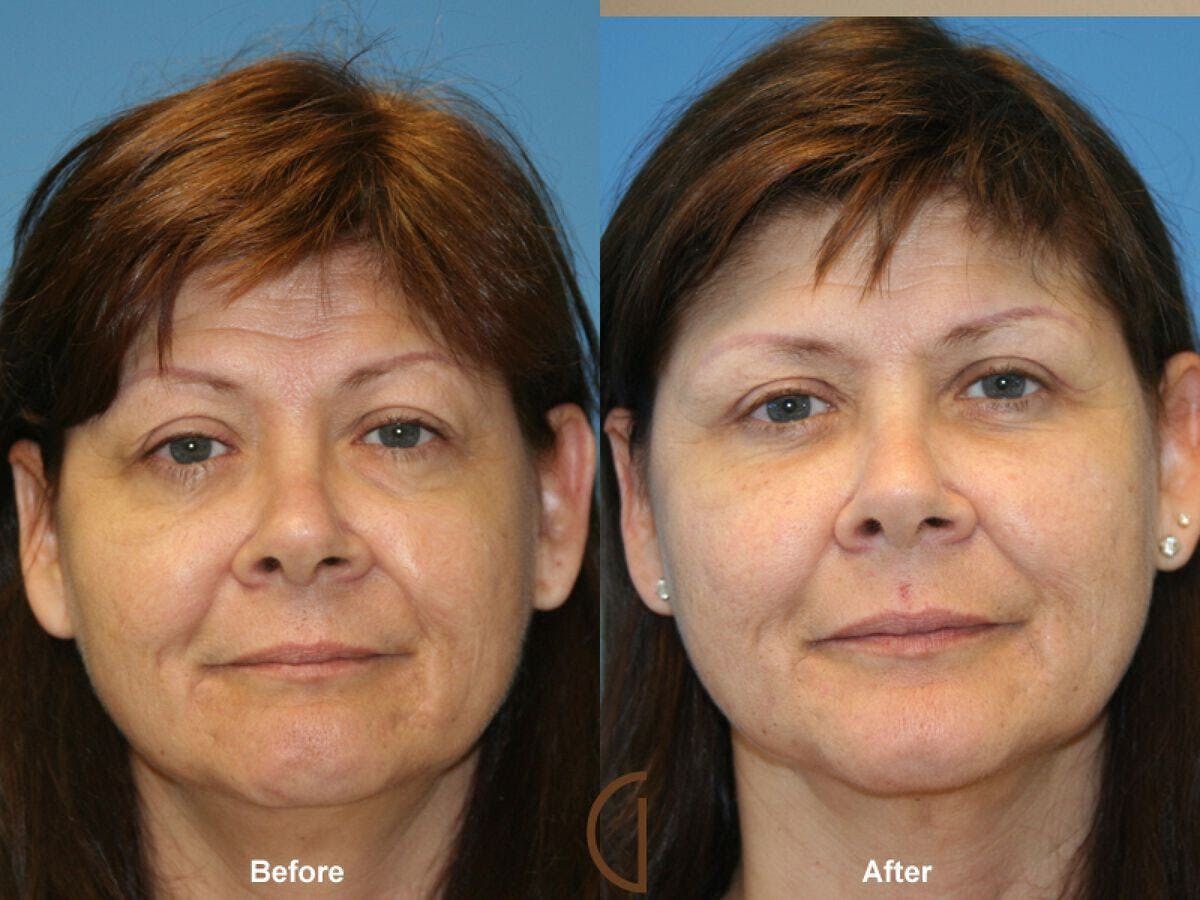 Facial Fat Grafting Before & After Gallery - Patient 352285 - Image 1