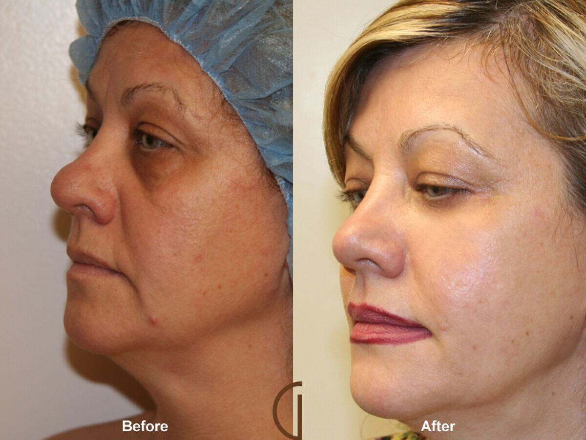 Facial Fat Grafting Before & After Gallery - Patient 310331 - Image 1