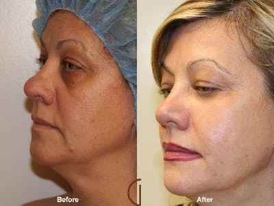 Facial Fat Grafting Before & After Gallery - Patient 310331 - Image 1