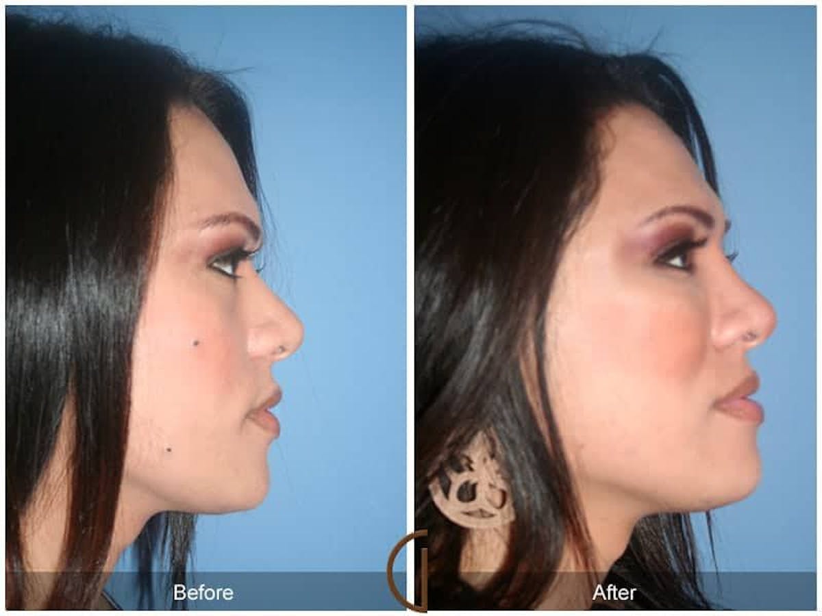 Facial Fat Grafting Before & After Gallery - Patient 637341 - Image 3