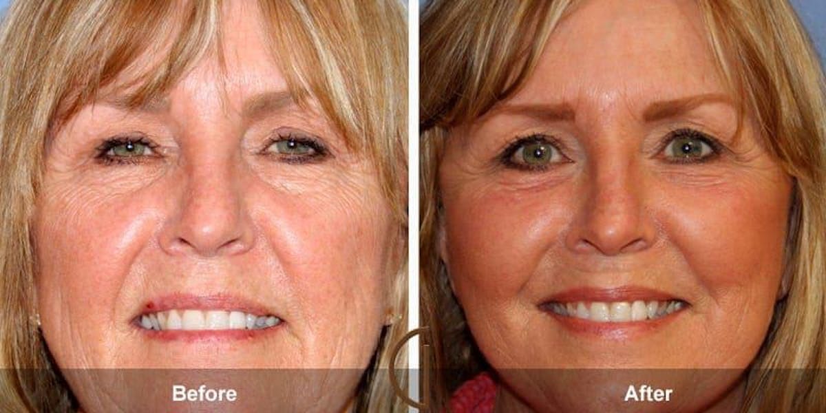 Eyelid Lift Before & After Gallery - Patient 140783 - Image 1