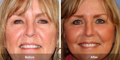 Eyelid Lift Before & After Gallery - Patient 140783 - Image 1
