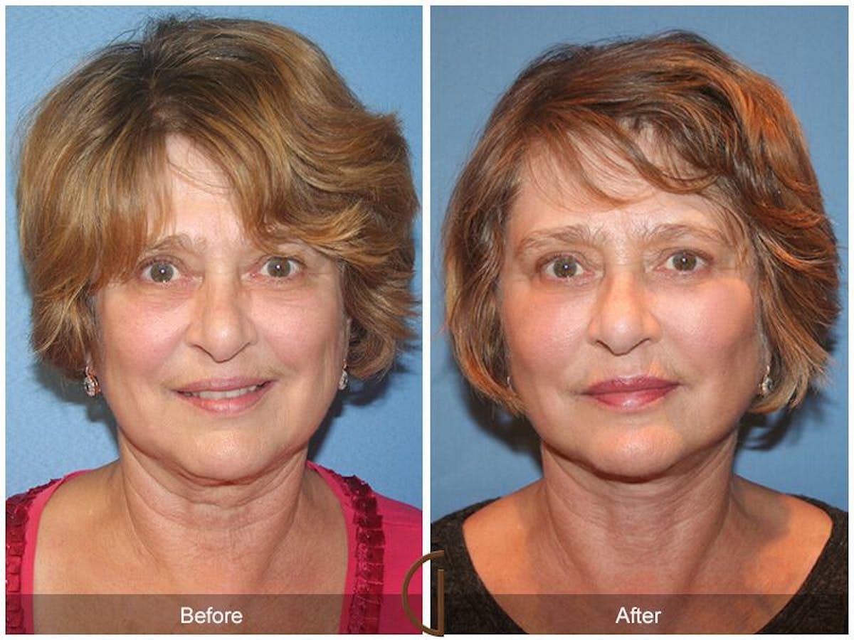 Facial Fat Grafting Before & After Gallery - Patient 357552 - Image 2